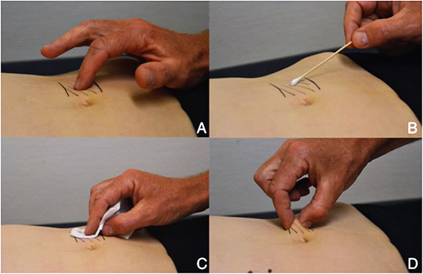 Localization of the painful trigger point (the patient is lying on his back) is detected by palpation. The pain increases with raising the head (Carnet test). Impaired skin sensitivity over the projection of the trigger point is detected with a cotton swab (tactile sensitivity) and a napkin moistened with alcohol (temperature sensitivity). Squeezing the skin folds with your fingers will be painful compared to the opposite side.